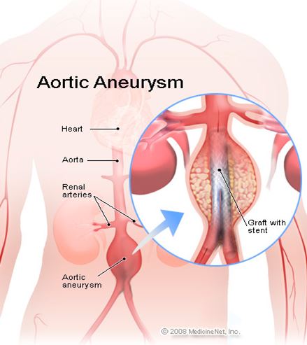 a diagram of an Aortic Aneuysm